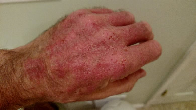 Eczema on left hand before remedies