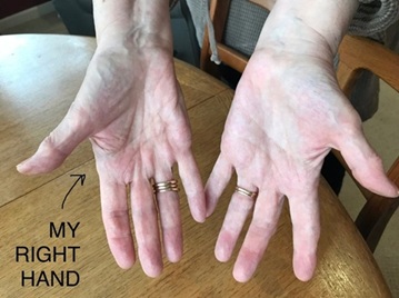 Lyme hands after Radiac