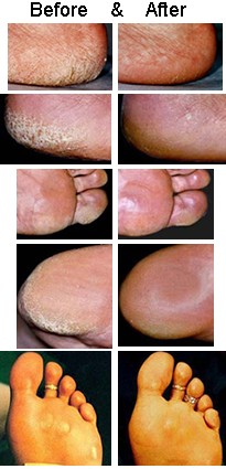 Before and After Using CalleX, Callus Ointment