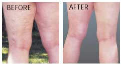 Before and After Vein Gard Use