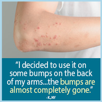 I decided to use it on some bumps on the back of my arms... The bumps are almost completely gone. - K., NY