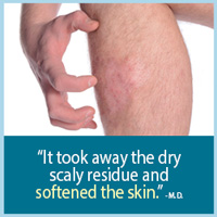It took away the dry scaly residue, and softened the skin. - M.D.